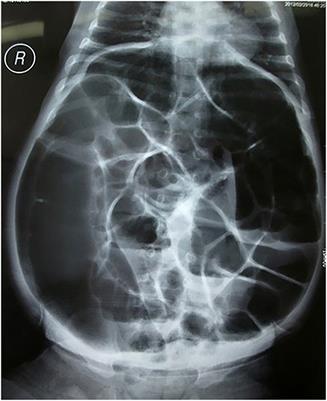 Enterocolitis Is a Risk Factor for Bowel Perforation in Neonates With Hirschsprung's Disease: A Retrospective Multicenter Study